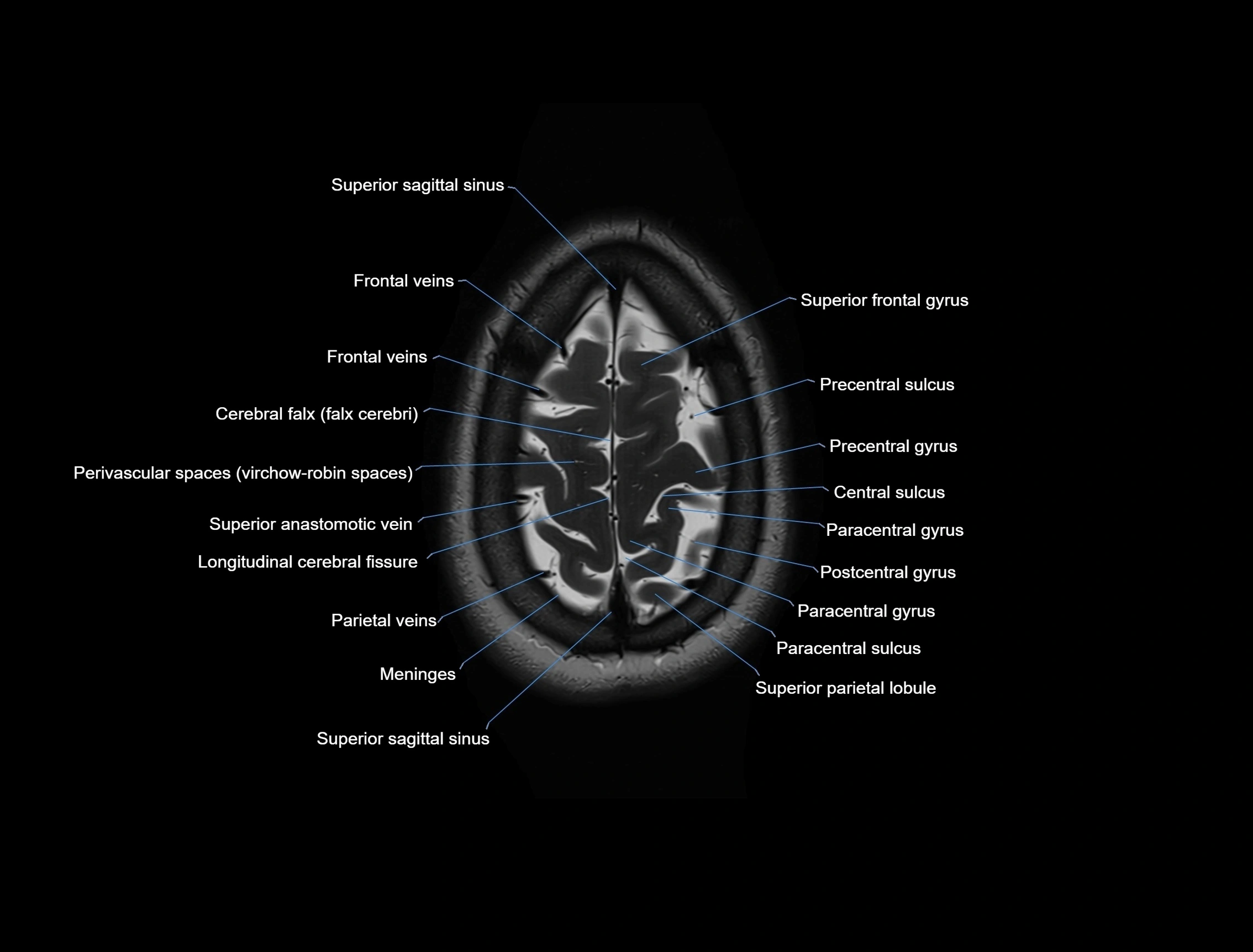 MRI Brain axial cross sectional radiology anatomy 3T image  -img-00001-00054.webp